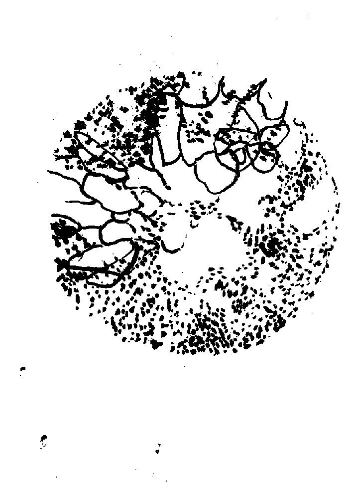 ink drawing of cystoscopy image of bladdder lining.